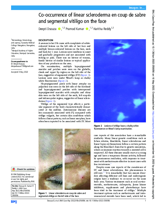 (PDF) Co-occurrence of linear scleroderma en coup de sabre and ...