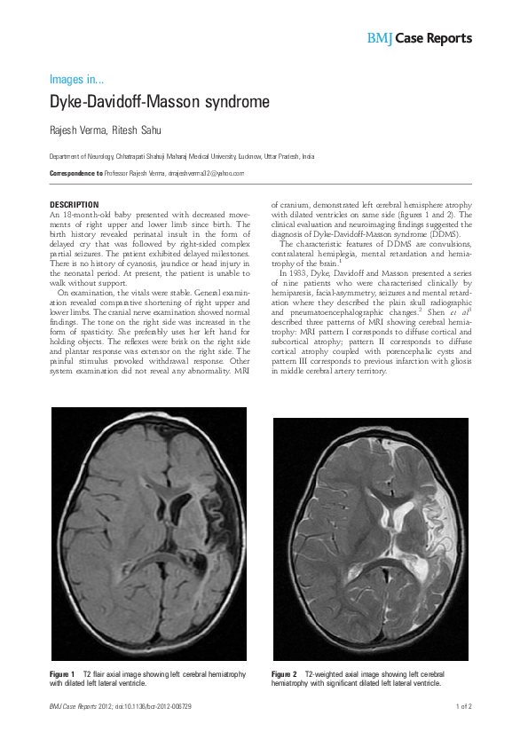(PDF) Dyke-Davidoff-Masson syndrome