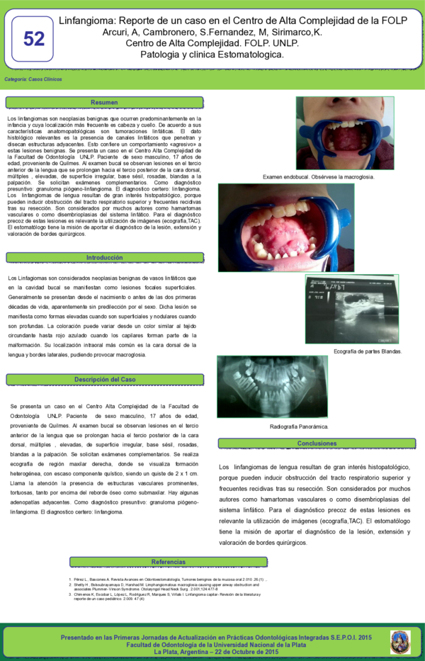 (PDF) Linfangioma: reporte de un caso en el Centro de Alta Complejidad ...