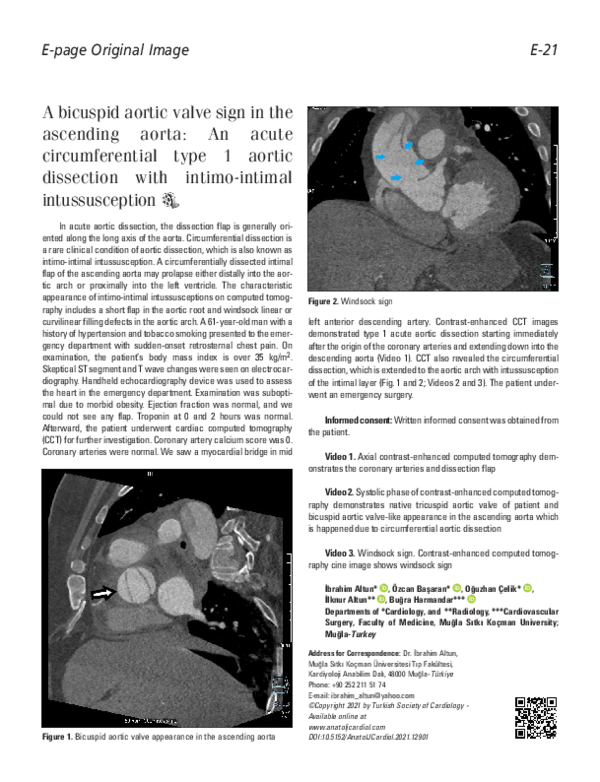 (PDF) A bicuspid aortic valv sign in ascending aorta: An acute ...