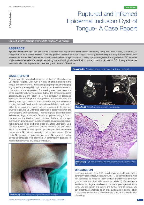 (PDF) Ruptured and Inflamed Epidermal Inclusion Cyst of Tongue- A Case ...