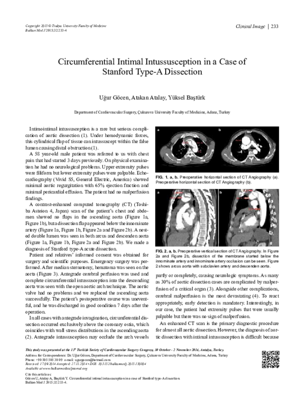 (PDF) Circumferential Intimal Intussusception in a Case of Stanford ...