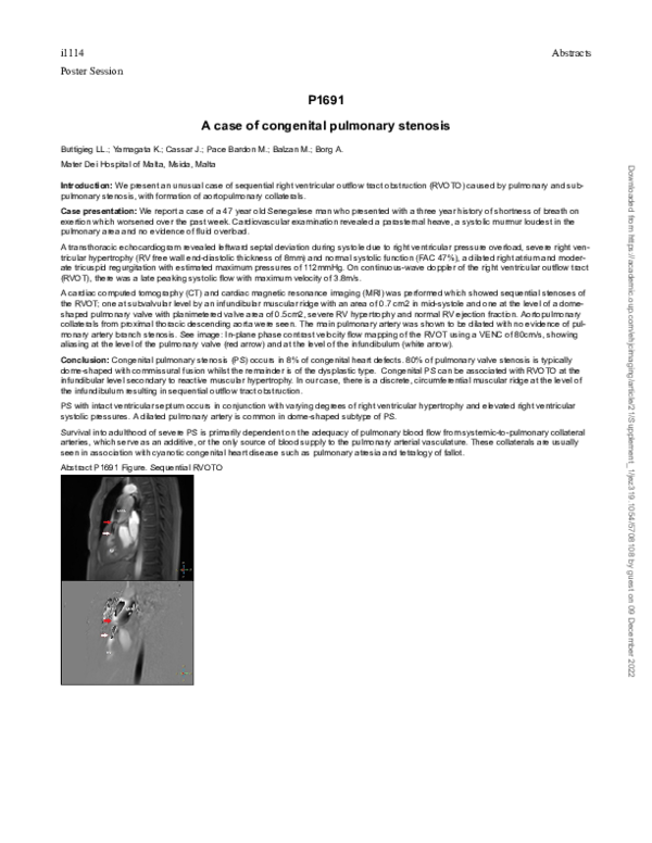 (PDF) P1691 A case of congenital pulmonary stenosis
