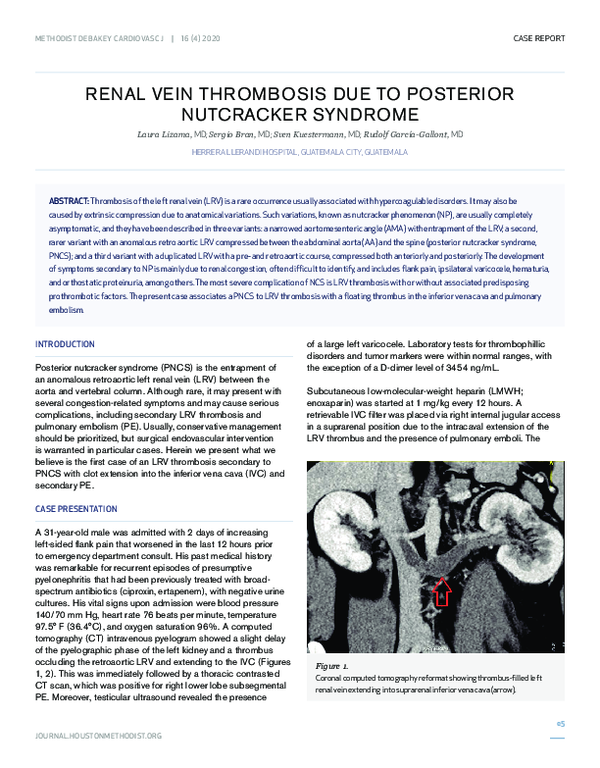 (PDF) Renal Vein Thrombosis due to Posterior Nutcracker Syndrome