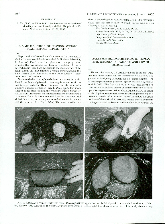 (PDF) One-Stage Reconstruction in Human Bite Injuries of Earlobe and ...