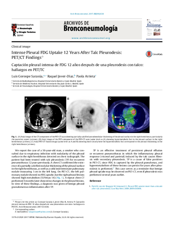 (PDF) Intense pleural FDG uptake 12 years after talc pleurodesis: PET ...