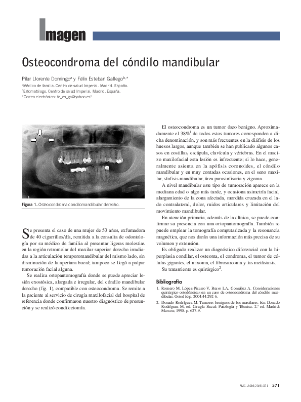 (PDF) Osteocondroma del cóndilo mandibular