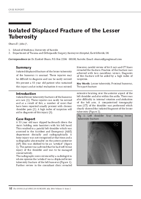 (PDF) Isolated Displaced Fracture of the Lesser Tuberosity | Ezekiel ...