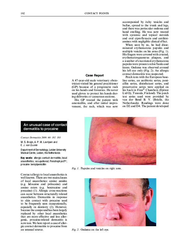 (PDF) An unusual case of contact dermatitis to procaine
