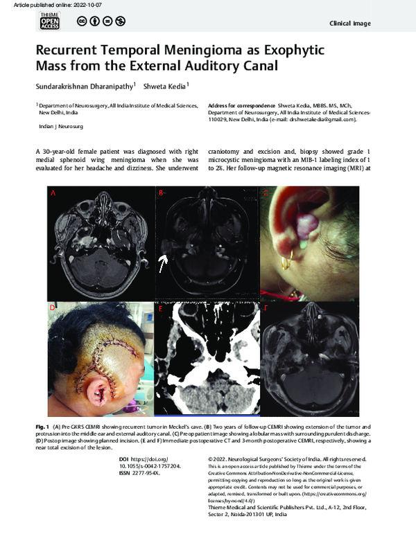 (PDF) Recurrent Temporal Meningioma as Exophytic Mass from the External ...