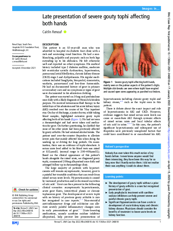 (PDF) Late presentation of severe gouty tophi affecting both hands