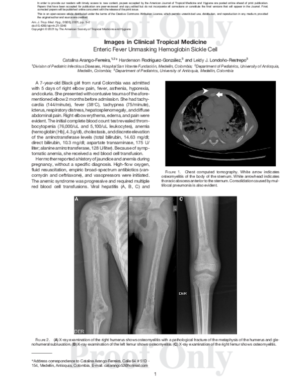 (PDF) Enteric Fever Unmasking Hemoglobin SC Disease