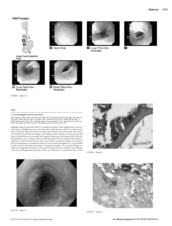(PDF) A Case of Esophagitis Dessicans Superficialis