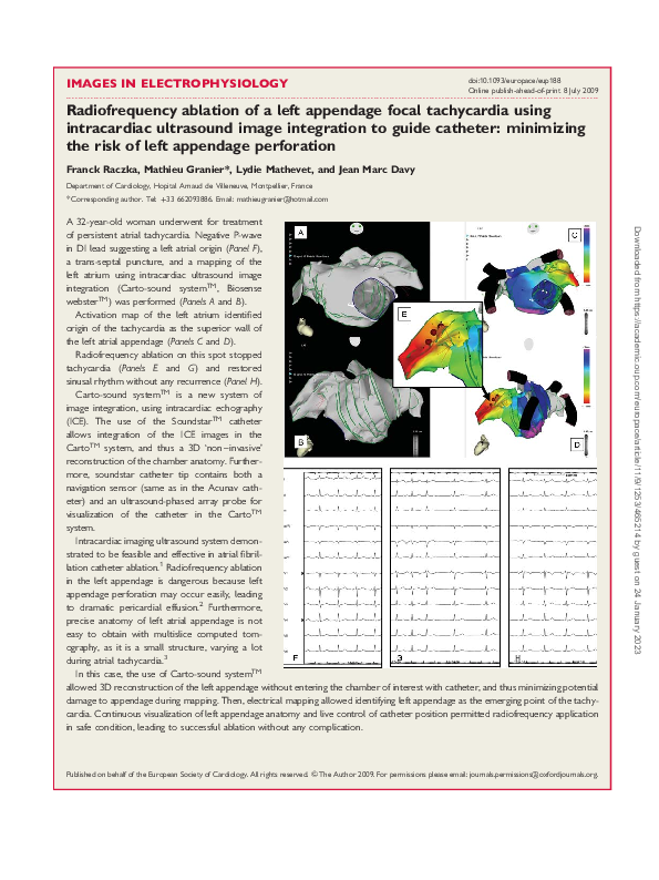 (PDF) Radiofrequency ablation of a left appendage focal tachycardia ...