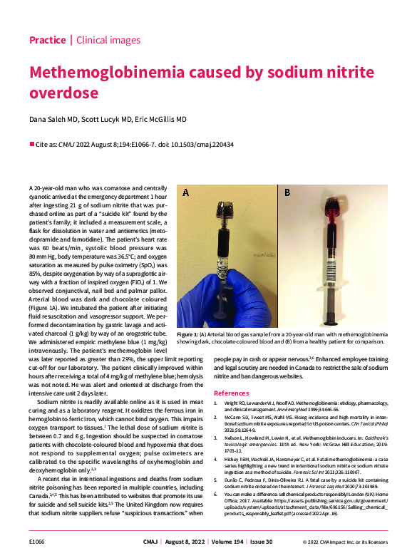 (PDF) Methemoglobinemia caused by sodium nitrite overdose