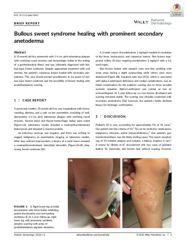 (PDF) Bullous sweet syndrome healing with prominent secondary anetoderma