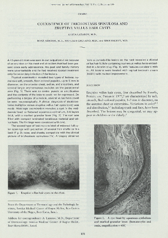 (PDF) Coexistence of Trichostasis Spinulosa and Eruptive Vellus Hair