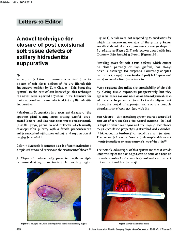 (PDF) A novel technique for closure of post excisional soft tissue ...