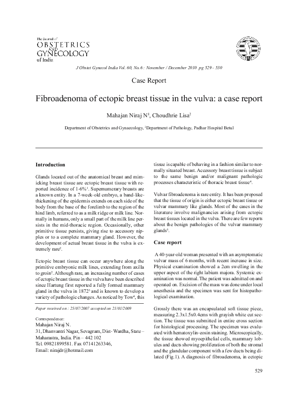 (PDF) Fibroadenoma of ectopic breast tissue in the vulva: a case report