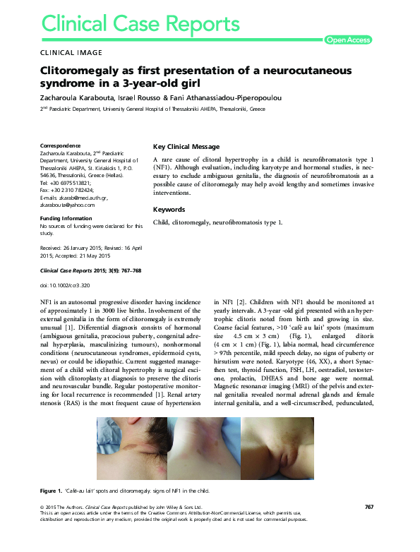 pdf-clitoromegaly-as-first-presentation-of-a-neurocutaneous-syndrome